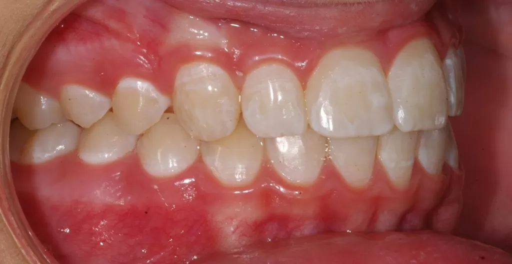 Неровности на зубах, пятна, сколы и трещины - не добавляют вам красоты даже при проведенной пластике губ